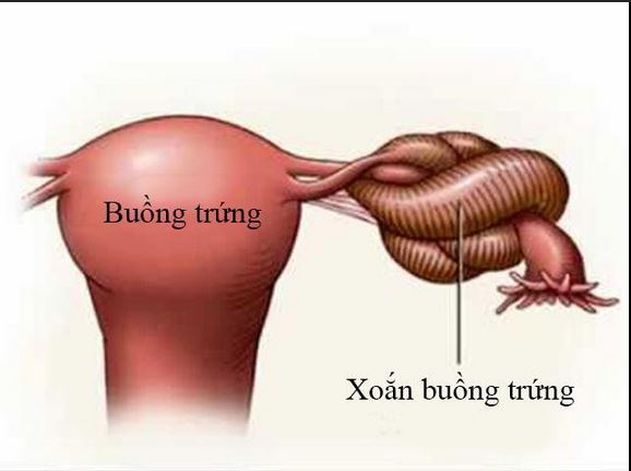 Những Điều Cần Biết Về Xoắn U Nang Buồng Trứng: Triệu Chứng và Cách Điều Trị