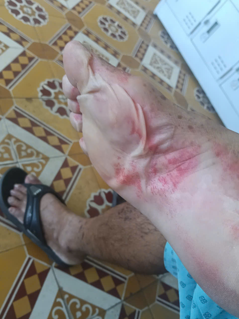 Dị ứng thuốc nhỏ mắt, người đàn ông bị hoại tử thượng bì nhiễm độc nguy kịch - Ảnh 4.