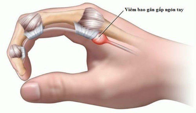 Những Điều Cần Biết Về Viêm Gân Gấp Ngón Tay: Triệu Chứng và Giải Pháp