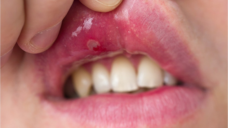 5 lưu ý chăm sóc răng miệng cho người bệnh Lupus ban đỏ- Ảnh 1.