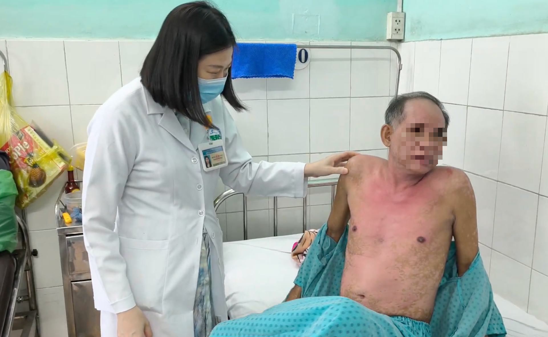 Dị ứng thuốc nhỏ mắt, người đàn ông bị hoại tử thượng bì nhiễm độc nguy kịch - Ảnh 5.