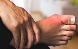 Cách Chạy Bộ Cho Người Bị Gout: Hướng Dẫn Để Ngăn Ngừa Tái Phát