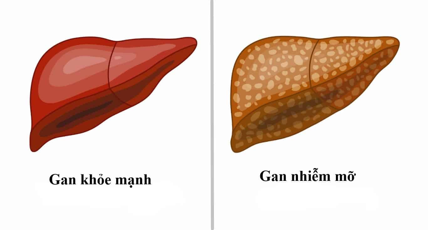 Gan nhiễm mỡ: Những Điều Cần Biết Để Điều Trị Hiệu Quả - Ảnh 1.