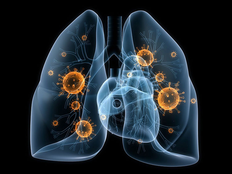 Cách Nhận Diện Sớm Viêm Phổi Do Adenovirus Ở Trẻ Nhỏ