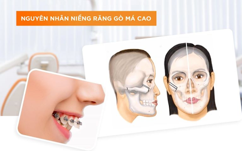 Khám Phá Nguyên Nhân Gây Hóp Má Khi Niềng Răng Và Cách Giải Quyết Hiệu Quả