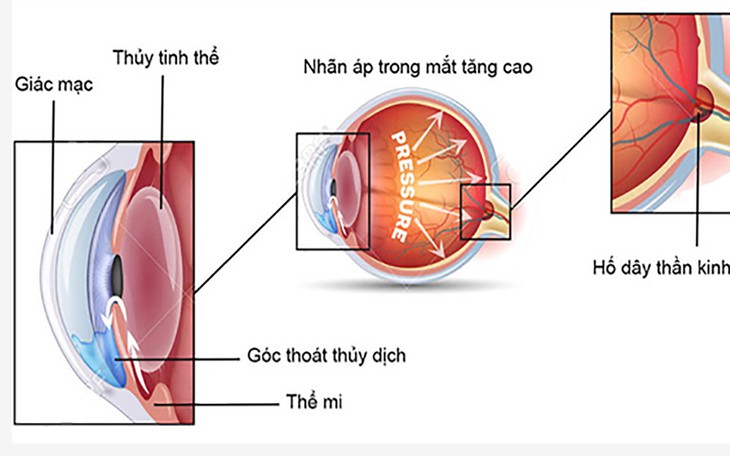 Giải thích về Tăng Nhãn Áp