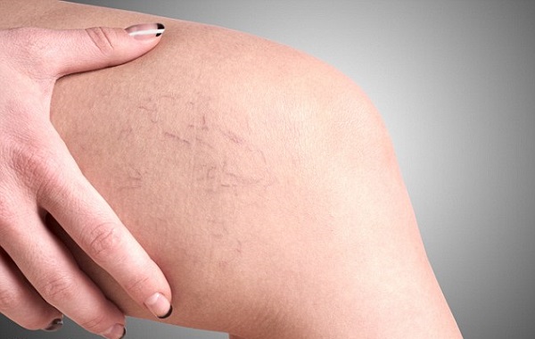 Biến Chứng Nguy Hiểm Do Suy Giãn Tĩnh Mạch Chân: Những Điều Cần Lưu Ý