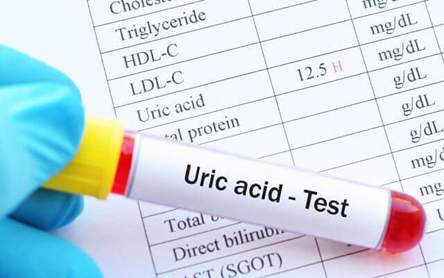 uric-acid-16983106537791692704412-0-0-400-640-crop-17577291099412035271772 Uống nước chanh mật ong mỗi ngày có làm tăng acid uric? - Ảnh 3.