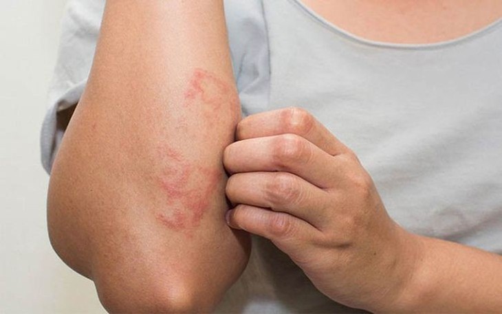 Cách Kiểm Soát Viêm Da Cơ Địa Hiệu Quả
