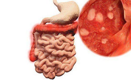 Viêm ruột có nguy hiểm không? - Ảnh 1.