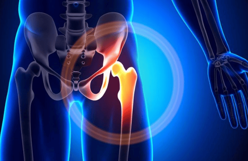 Các Dấu Hiệu Cảnh Báo Viêm Khớp Háng Ở Trẻ Mà Cha Mẹ Nên Biết