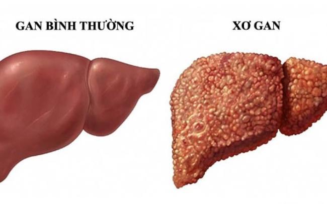 Những Dấu Hiệu Cảnh Báo Tổn Thương Gan Bạn Không Nên Bỏ Qua
