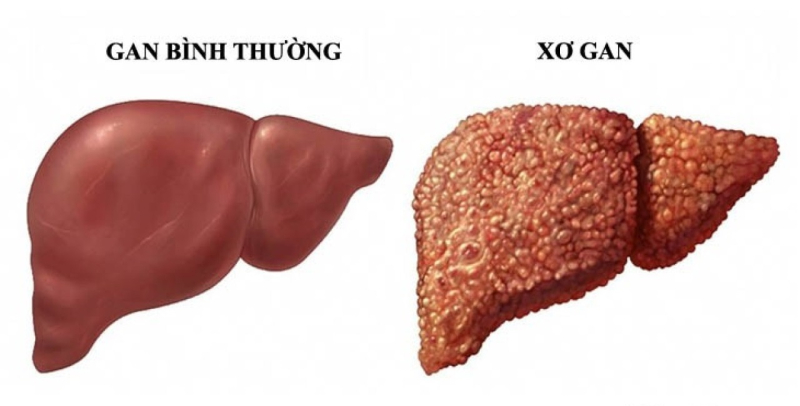 xo-gan-1785998873853387569737 Xơ gan có dẫn đến ung thư gan? Hiểu biết đúng để phòng bệnh hiệu quả - Ảnh 2.